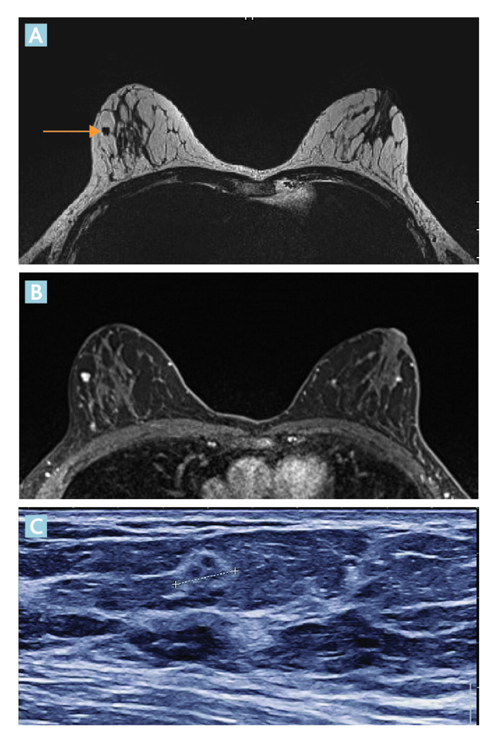 L’IRM mammaire chez les femmes présentant un variant BRCA pathogène de prédisposition au cancer du sein  - Figure 5