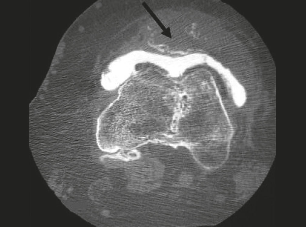 Une localisation métastatique inhabituelle d’un carcinome rénal à cellules claires : la patella-Figure 2