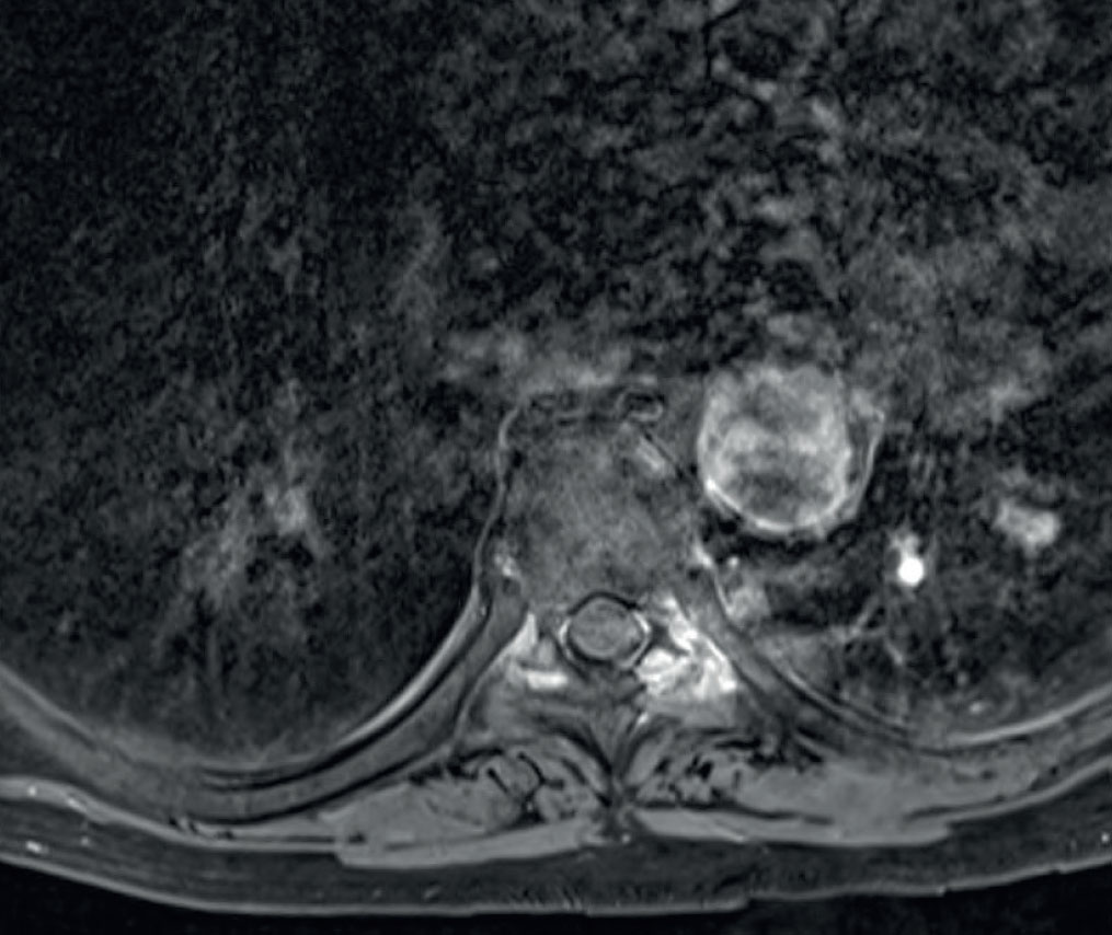 Une atteinte rachidienne ostéolytique fébrile révélatrice d’une goutte - Figure 4