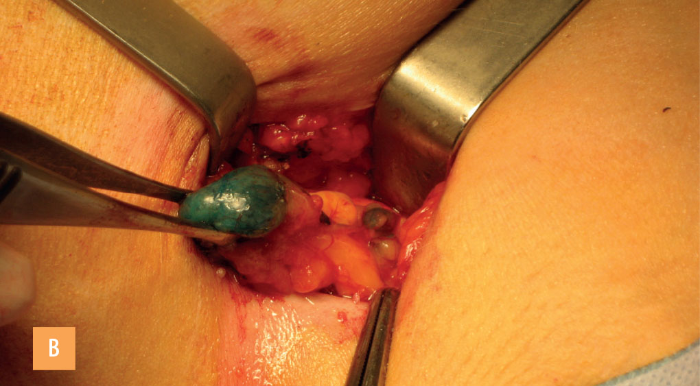 Chirurgie ambulatoire et curage axillaire - Figure 2b