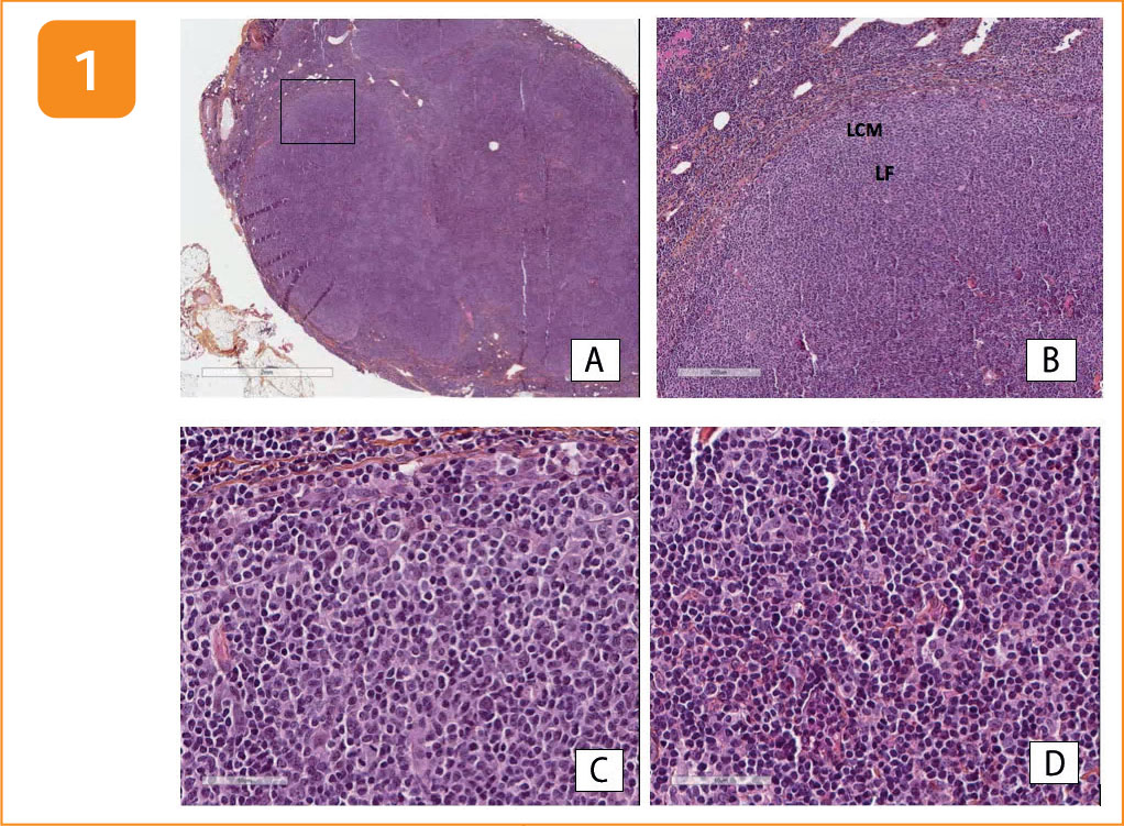Lymphome composite : association d'un lymphome folliculaire et d'un lymphome à cellules du manteau - Figure 1