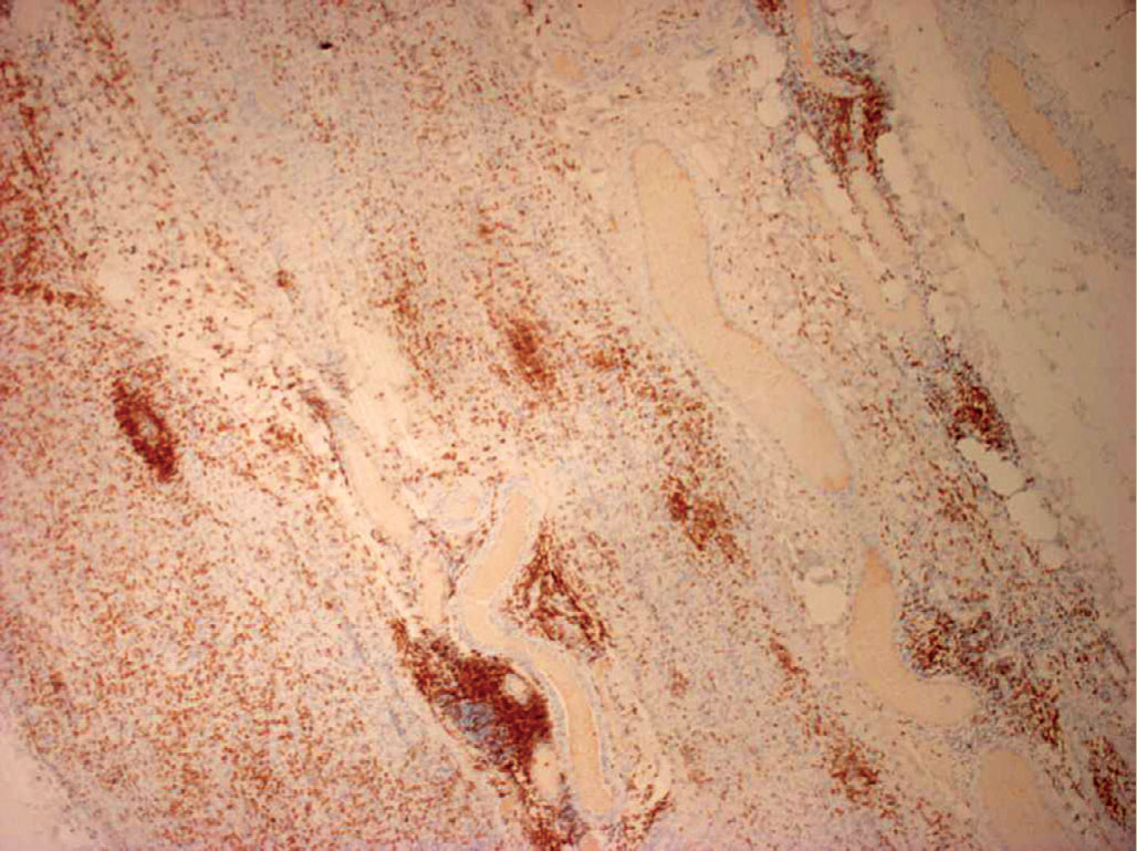 Une neuropathie froide révélée par un bain chaud - Figure 5