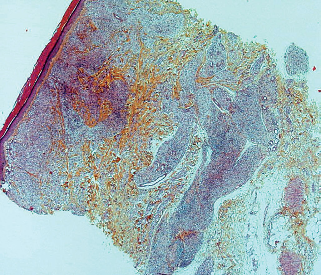 Une neuropathie froide révélée par un bain chaud - Figure 6