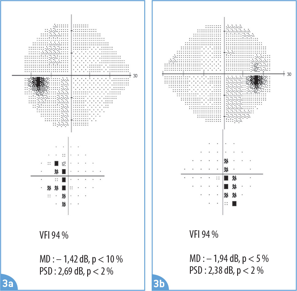 Pièges diagnostiques d'une baisse d'acuité visuelle progressive - Figure 3.