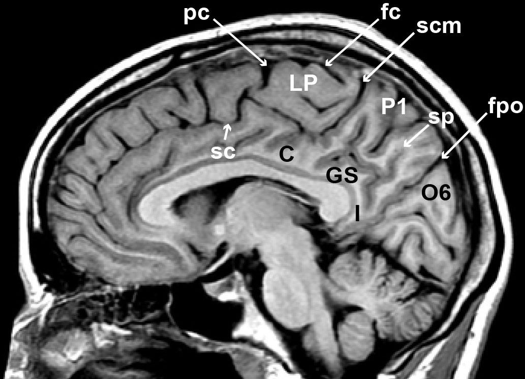Anatomie du cortex cérébral : lobe pariétal - Figure 3