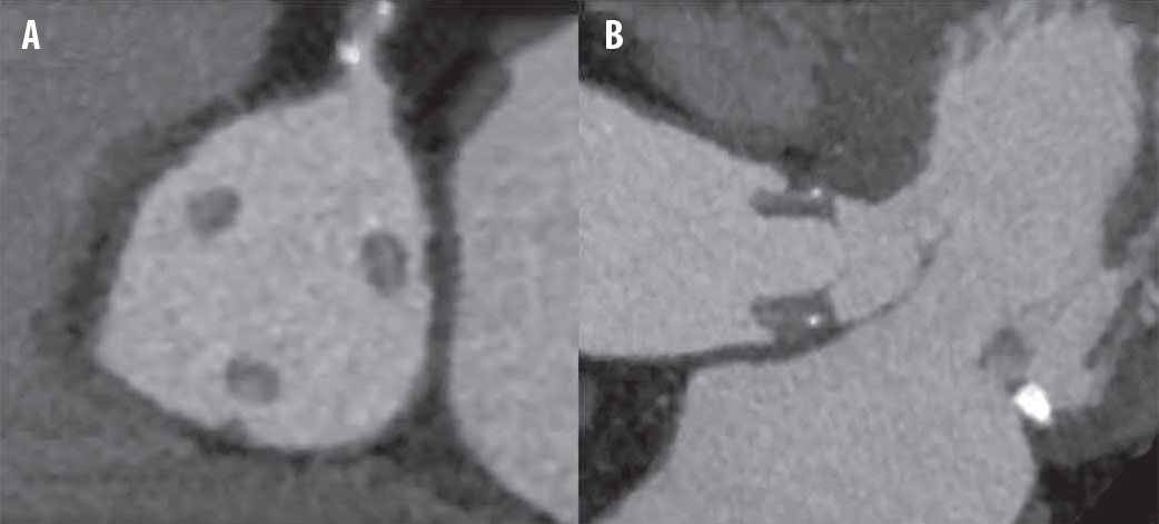 Thromboses de bioprothèses aortiques : une entité sous-estimée ? - Figure 3