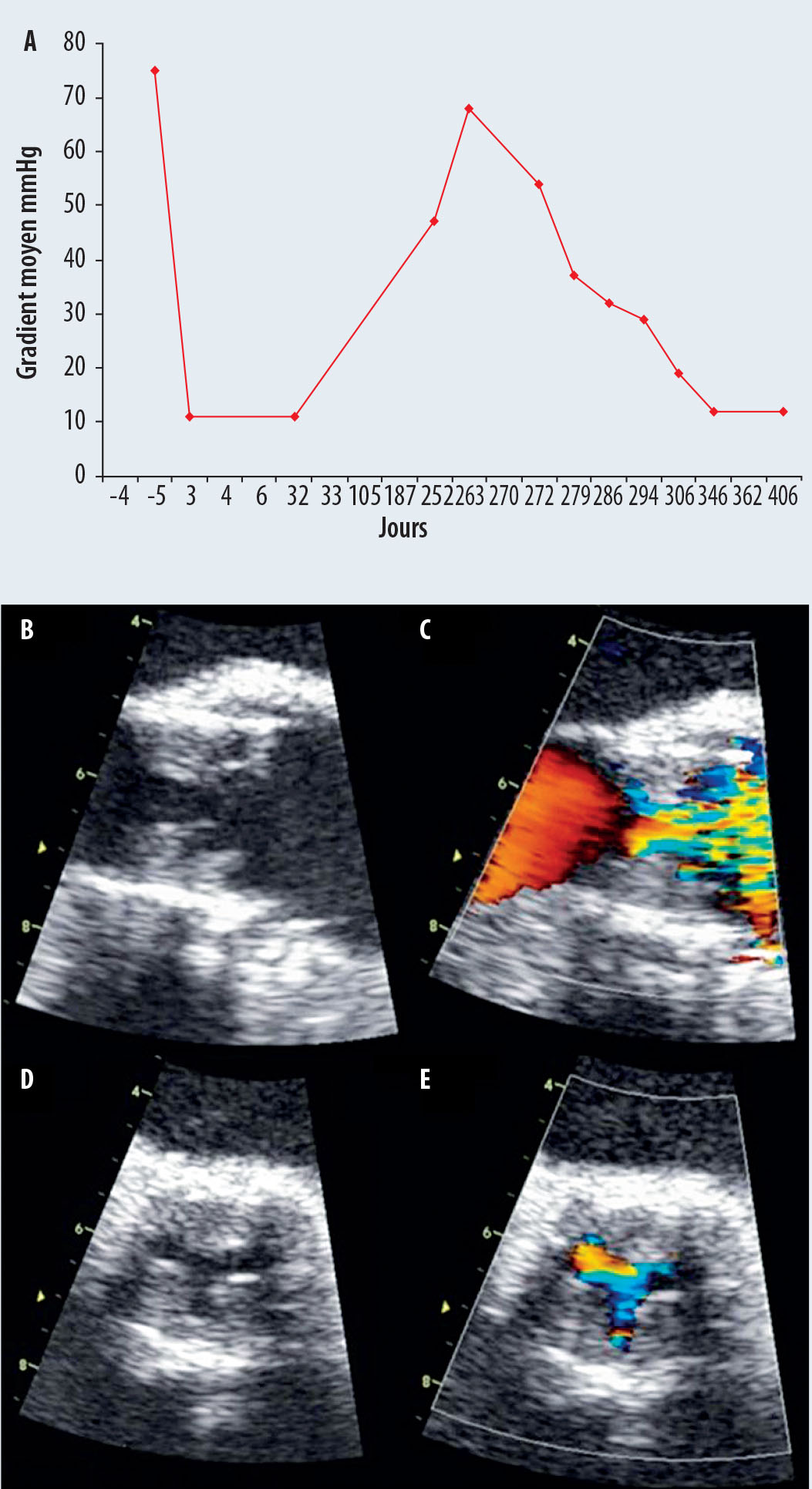 Thromboses de bioprothèses aortiques : une entité sous-estimée ? - Figure 1