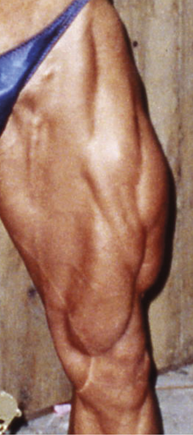 Muscles à haut risque - Figure 3