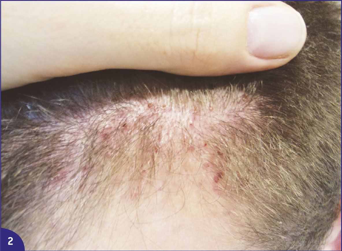 Une dermatose chronique du cuir chevelu… puis un syndrome ...