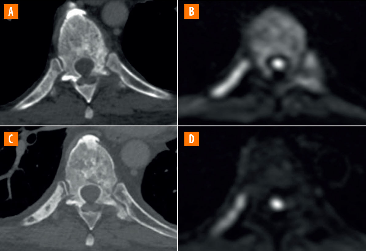 IRM corps entier dans le cancer de la prostate - Figure 3