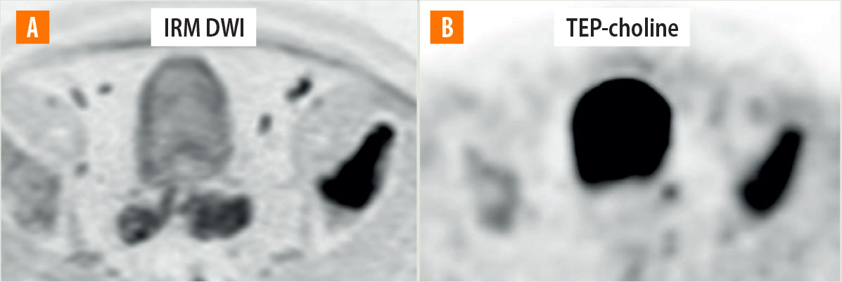 IRM corps entier dans le cancer de la prostate - Figure 4
