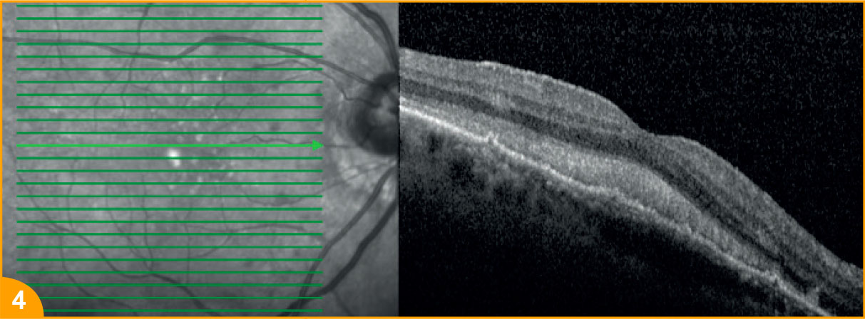 Lymphome intra-oculaire bilatéral - Figure 4