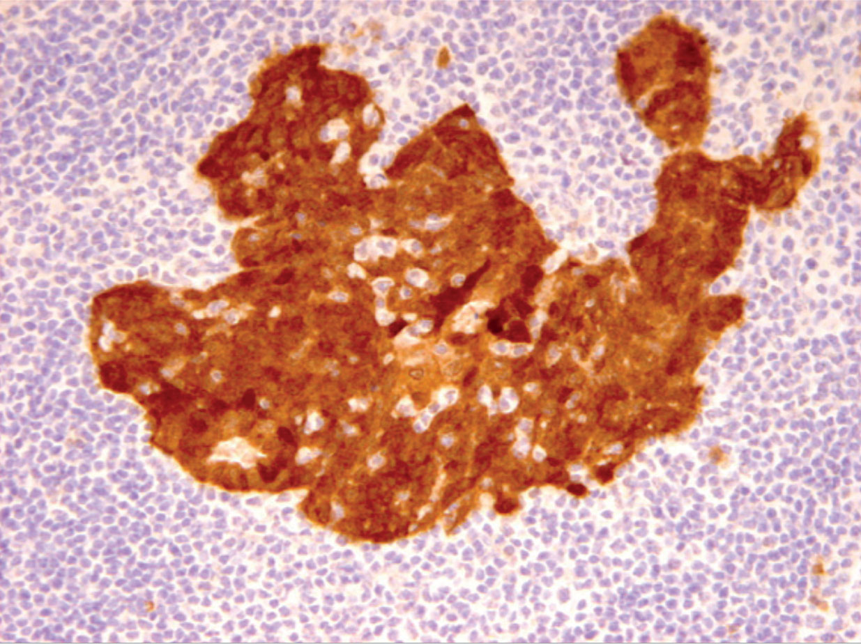 Rôle du HPV dans les cancers des VADS et particularités chez la femme - Figure 3