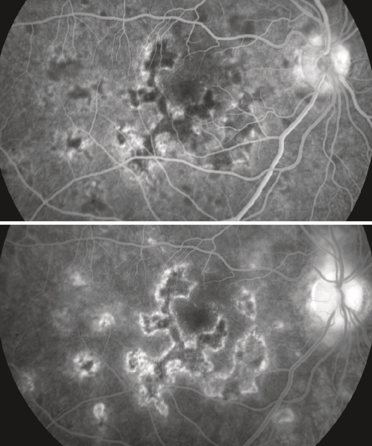 Intérêt de l’angiographie à la fluorescéine dans le diagnostic de taches blanches du fond d’œil - Figure 3