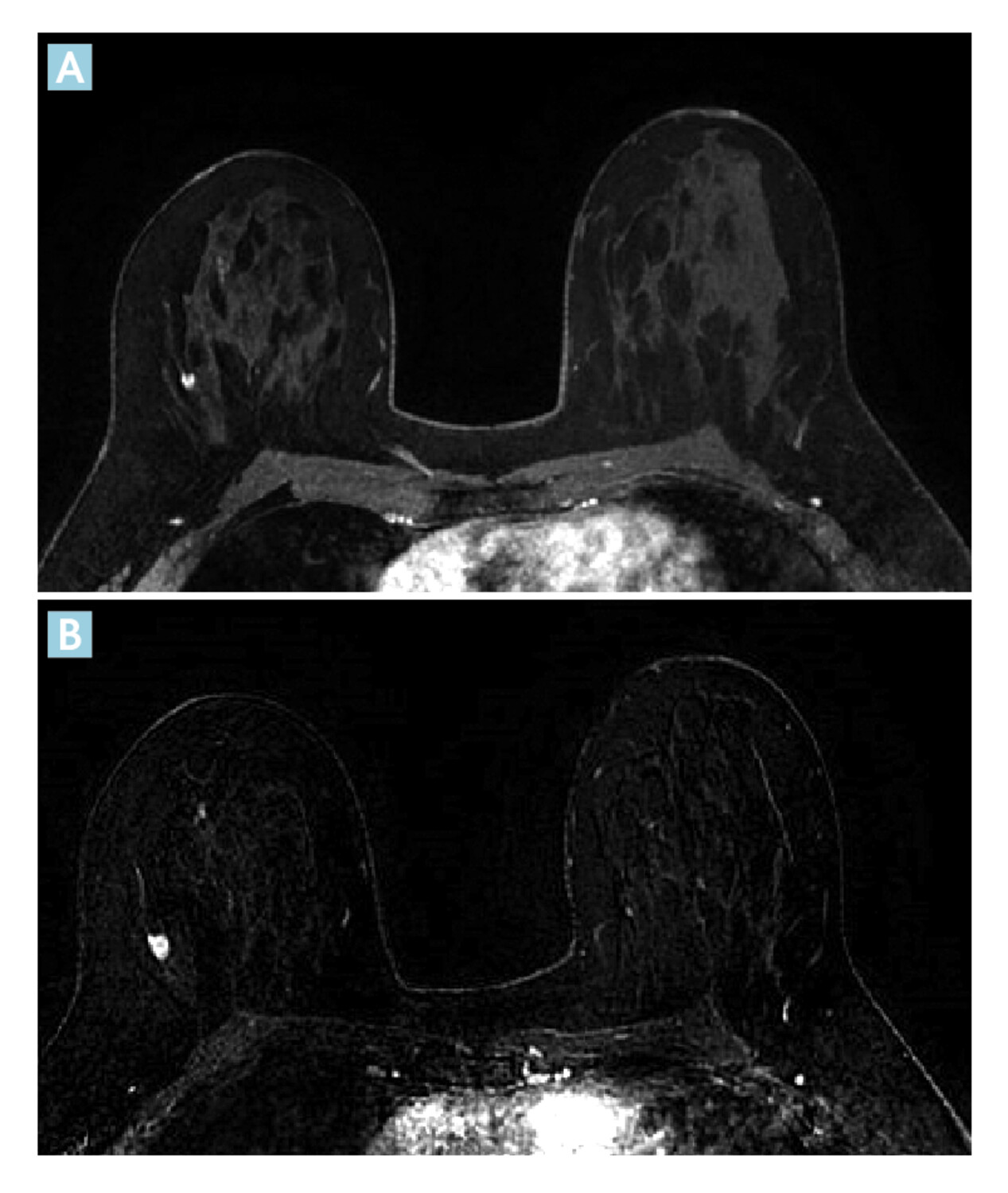 L’IRM mammaire chez les femmes présentant un variant BRCA pathogène de prédisposition au cancer du sein  - Figure 2
