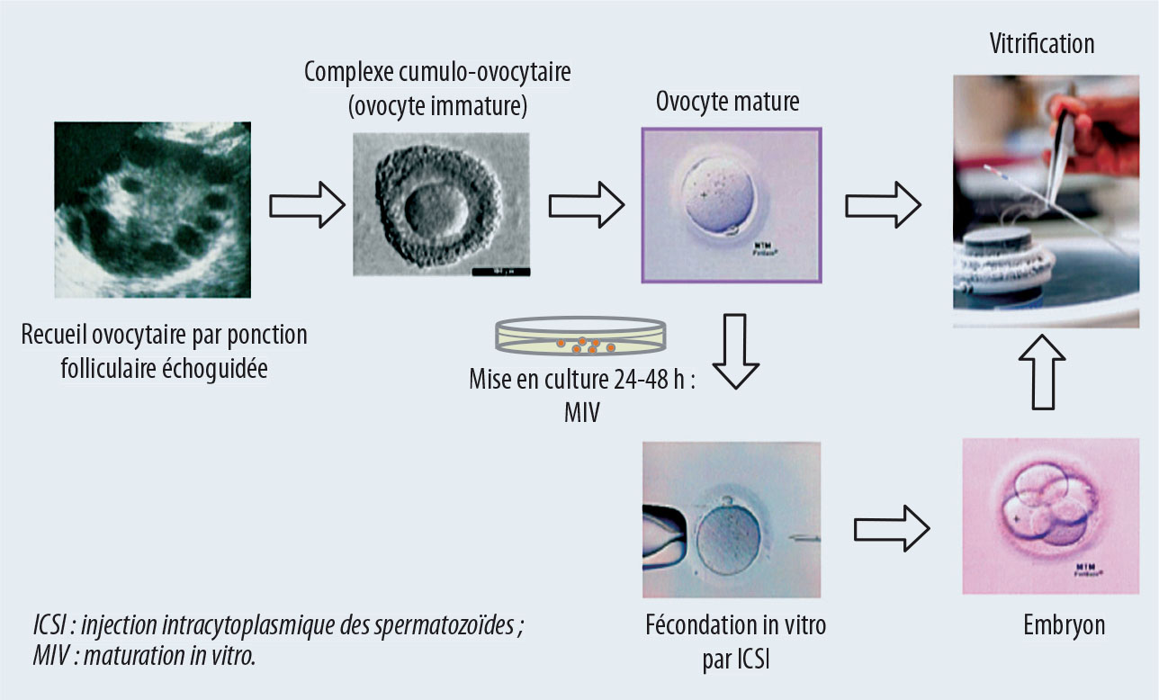 Préservation de la fertilité dans le cancer du sein - Figure 3