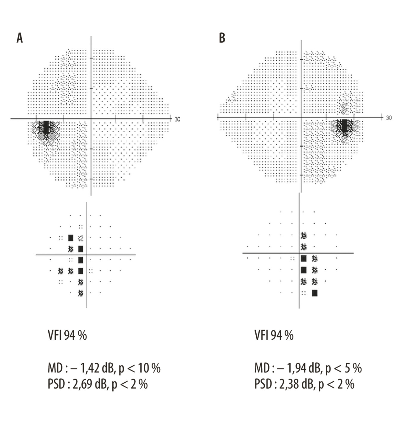 Pièges diagnostiques d'une baisse d'acuité visuelle progressive - Figure 3