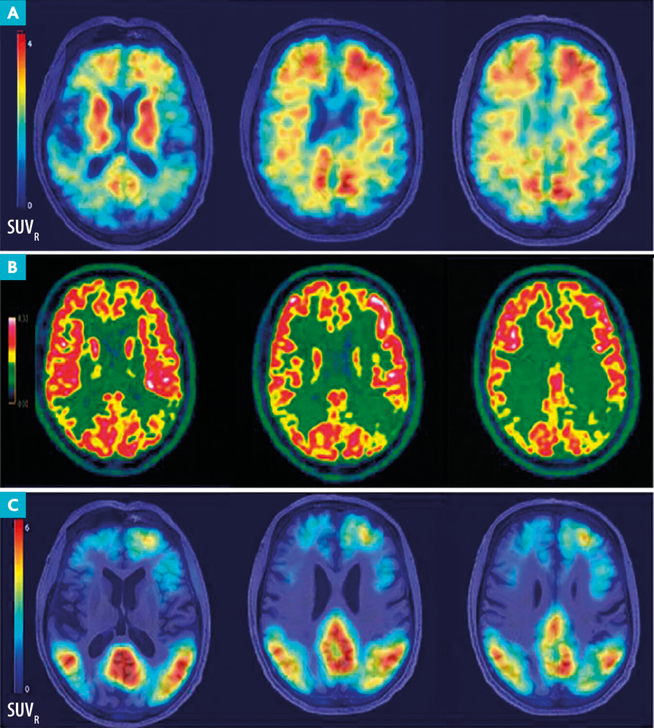 Imagerie TEP : intérêt des nouveaux ligands dans la maladie d’Alzheimer et les maladies apparentées - Figure 2