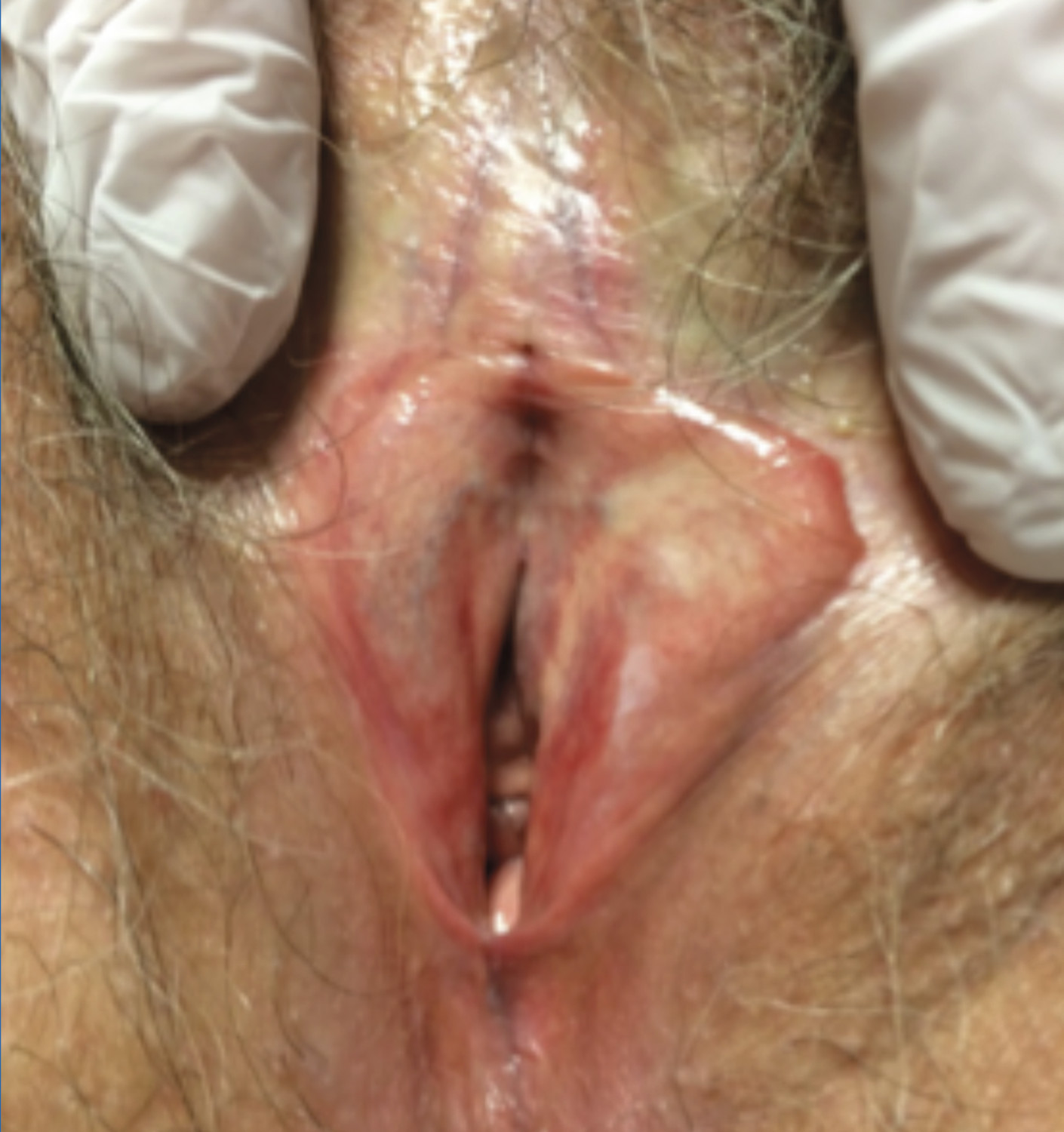 Consultation gynéco-dermatologique de pathologie vulvaire - Figure 4