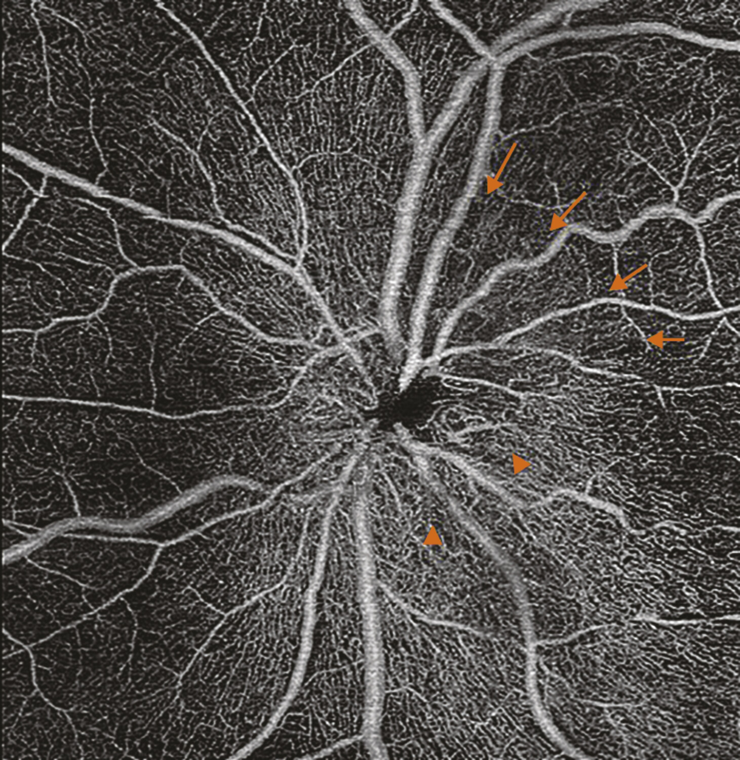 OCT-angiographie en neuro-ophtalmologie - Figure 1