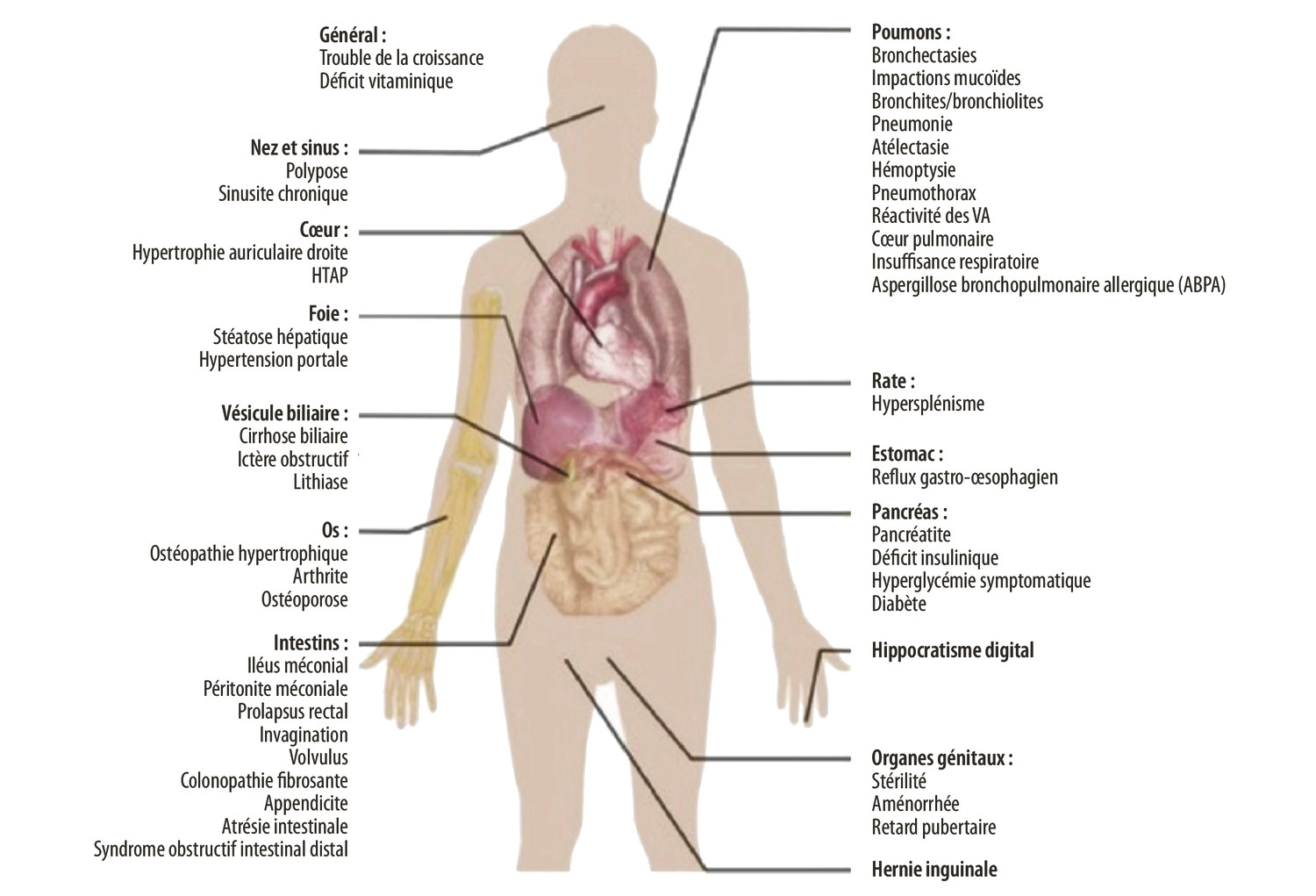 Physiopathologie et actualités de la prise en charge de la mucoviscidose - Figure 4
