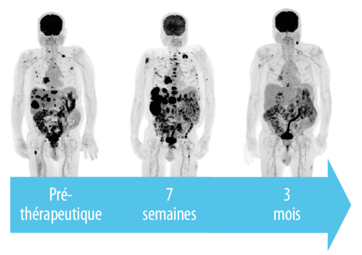 Intérêt de la TEP-TDM au 18FDG dans la prise en charge du cancer bronchique traité par immunothérapie - Figure 2
