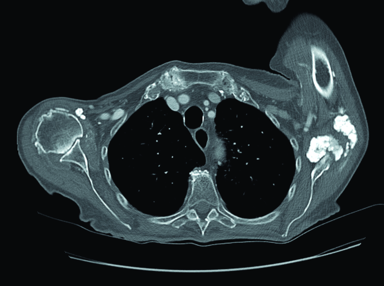 Une calcinose tumorale diffuse idiopathique - Figure 3