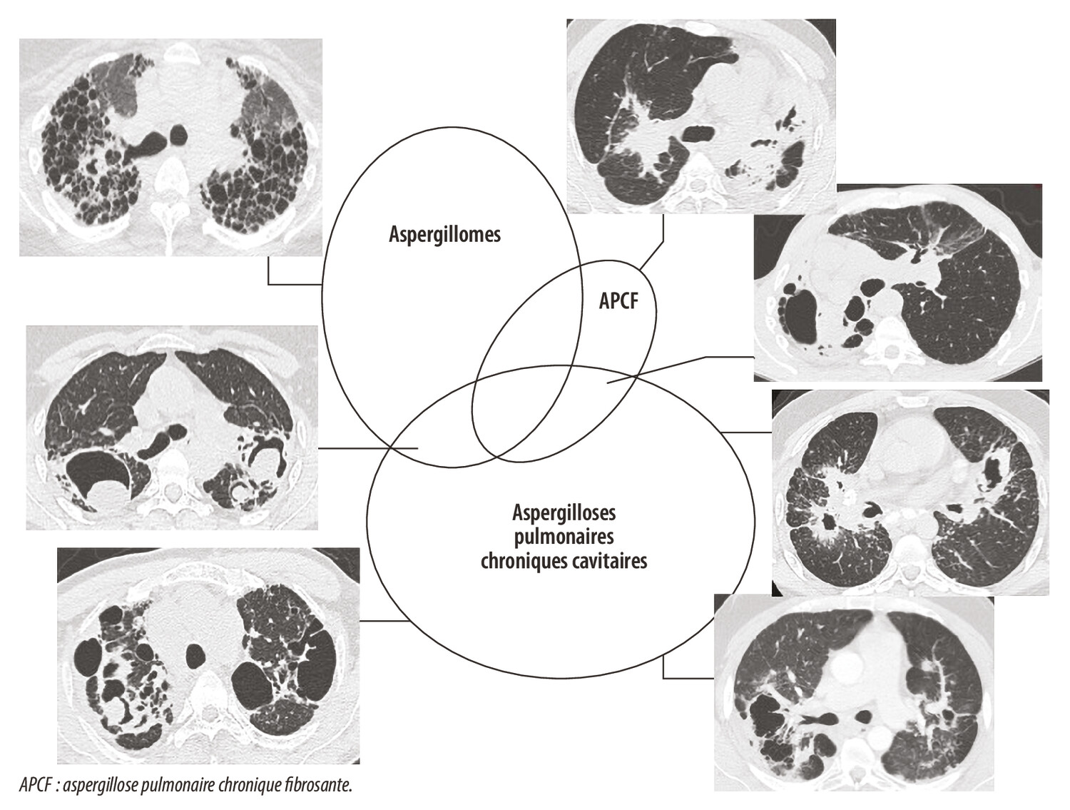Aspergillose pulmonaire chronique et sarcoïdose - Figure