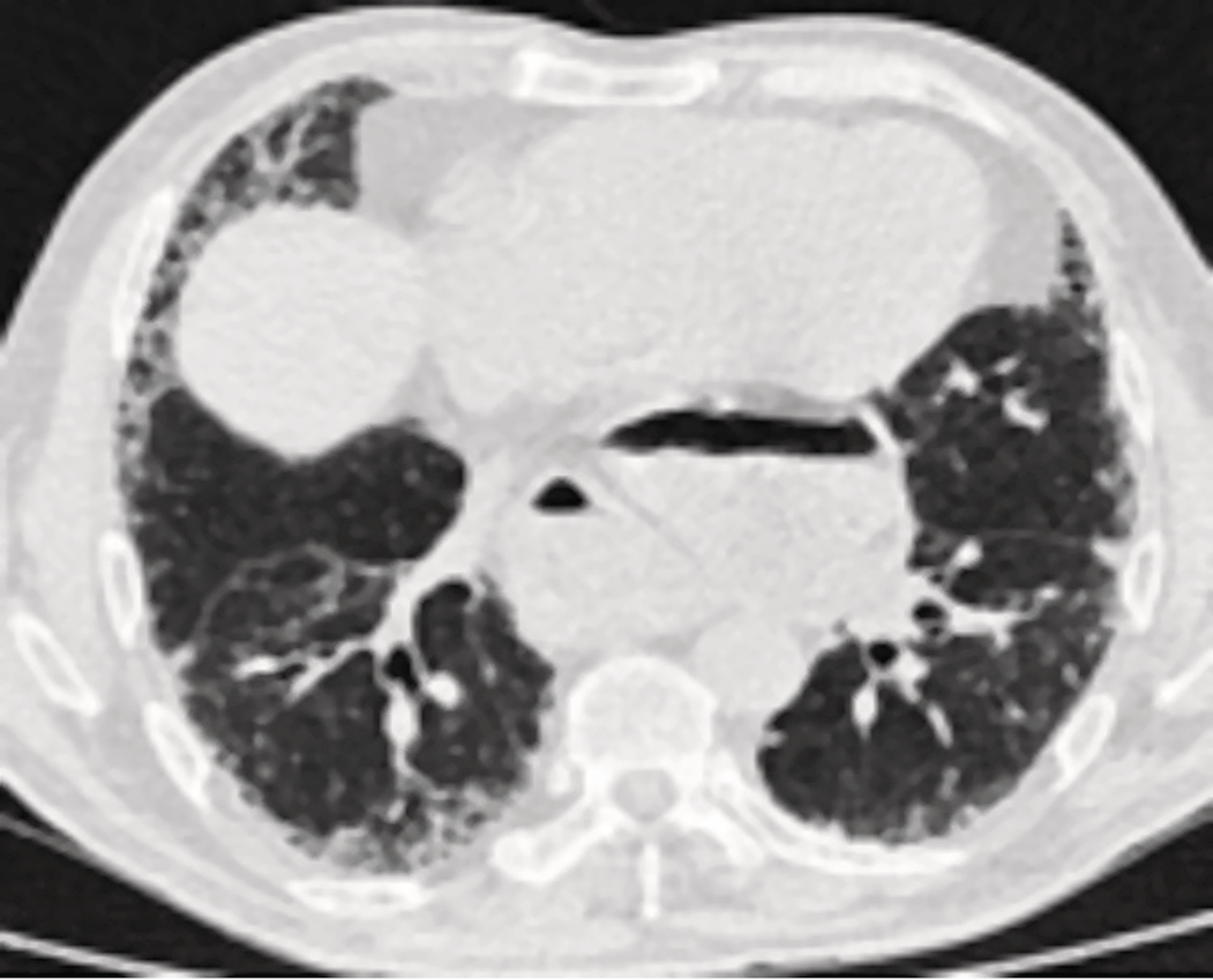 Le reflux gastro-œsophagien au cours de la fibrose pulmonaire idiopathique : cause, conséquence, ou coïncidence ? - Figure