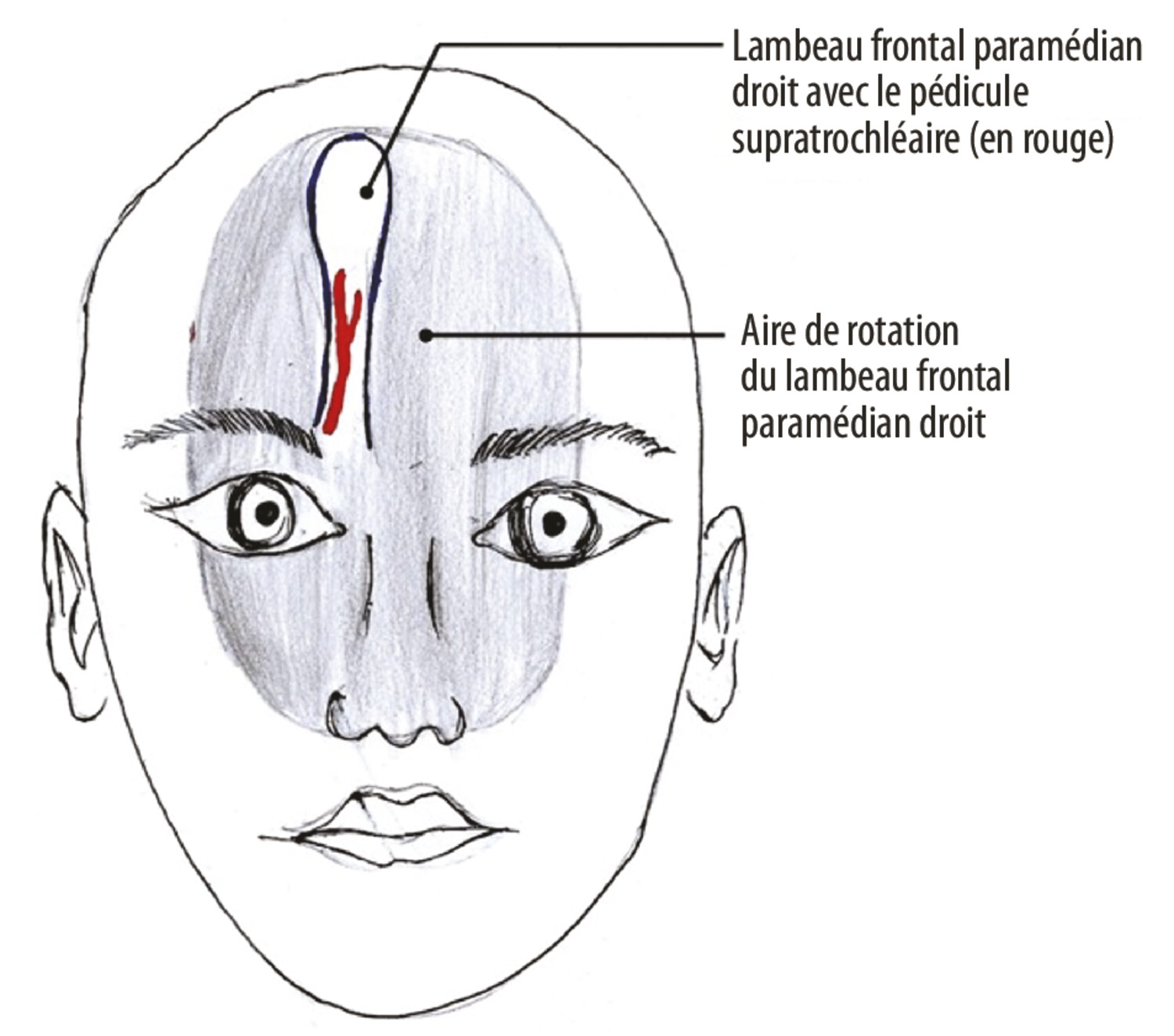 Reconstruction d’une perte de substance paracanthale interne par lambeau frontal paramédian myocutané - Figure 5