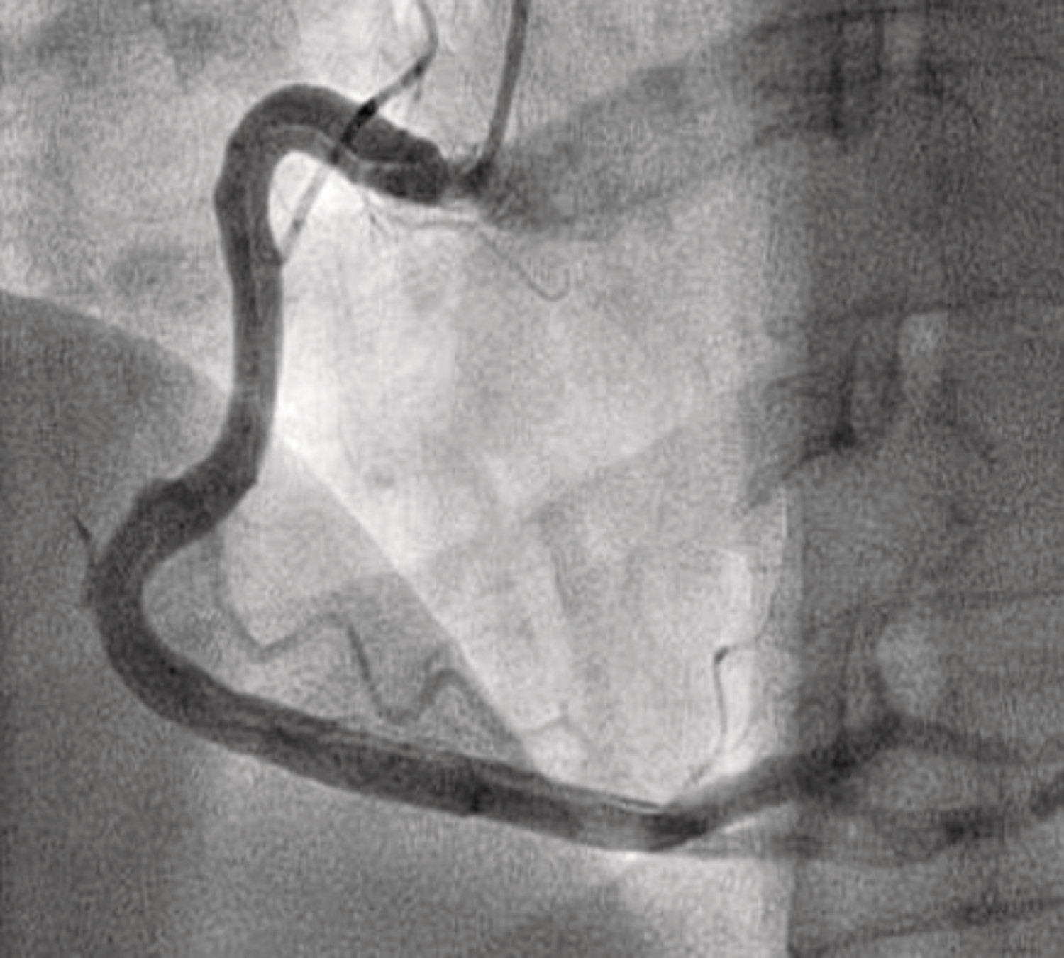 Dissection coronaire spontanée  - Figure 4