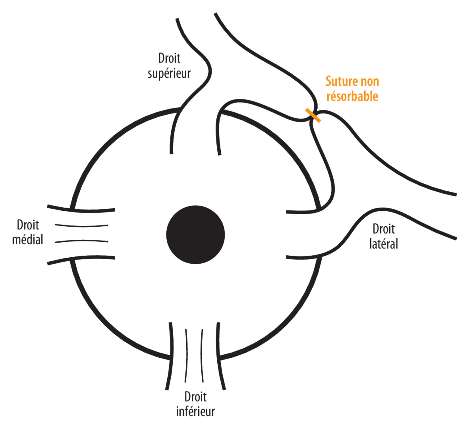 Syndrome de l’œil lourd  - Figure 3