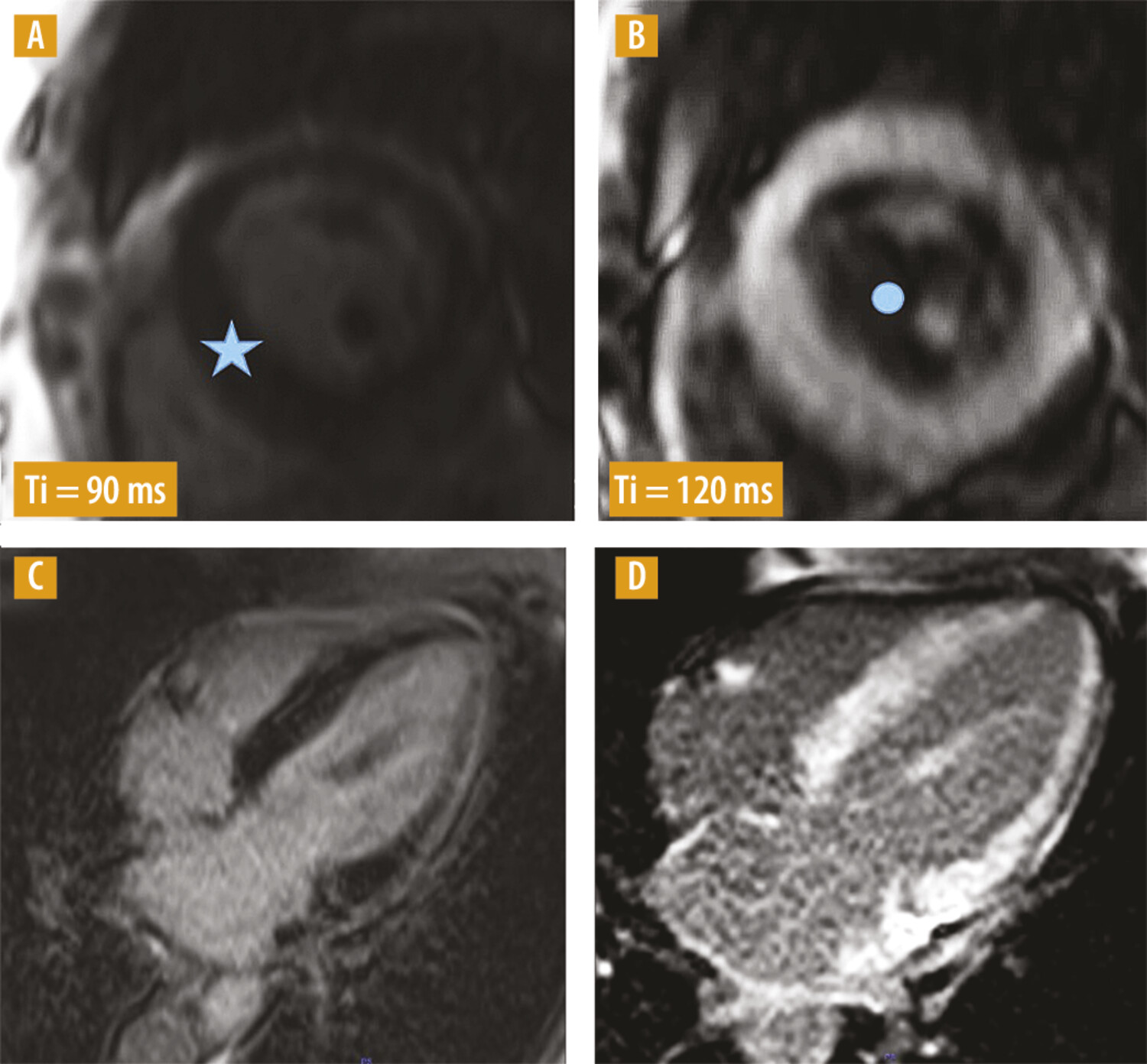 Le diagnostic de cardiopathie amyloïde en IRM cardiaque - Figure 2