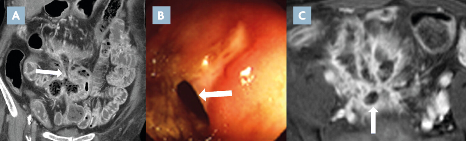 Imagerie en coupes actuelle de la maladie de Crohn (2e partie)  - Figure 5