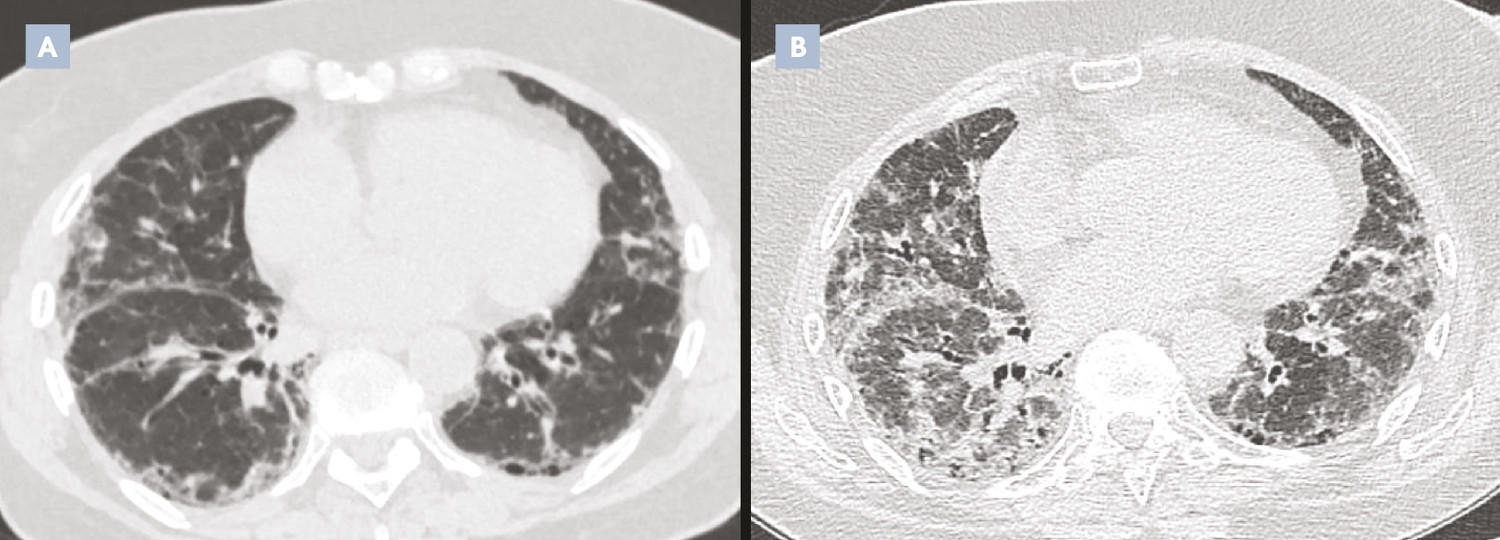Exacerbation aiguë de fibrose pulmonaire idiopathique - Figure