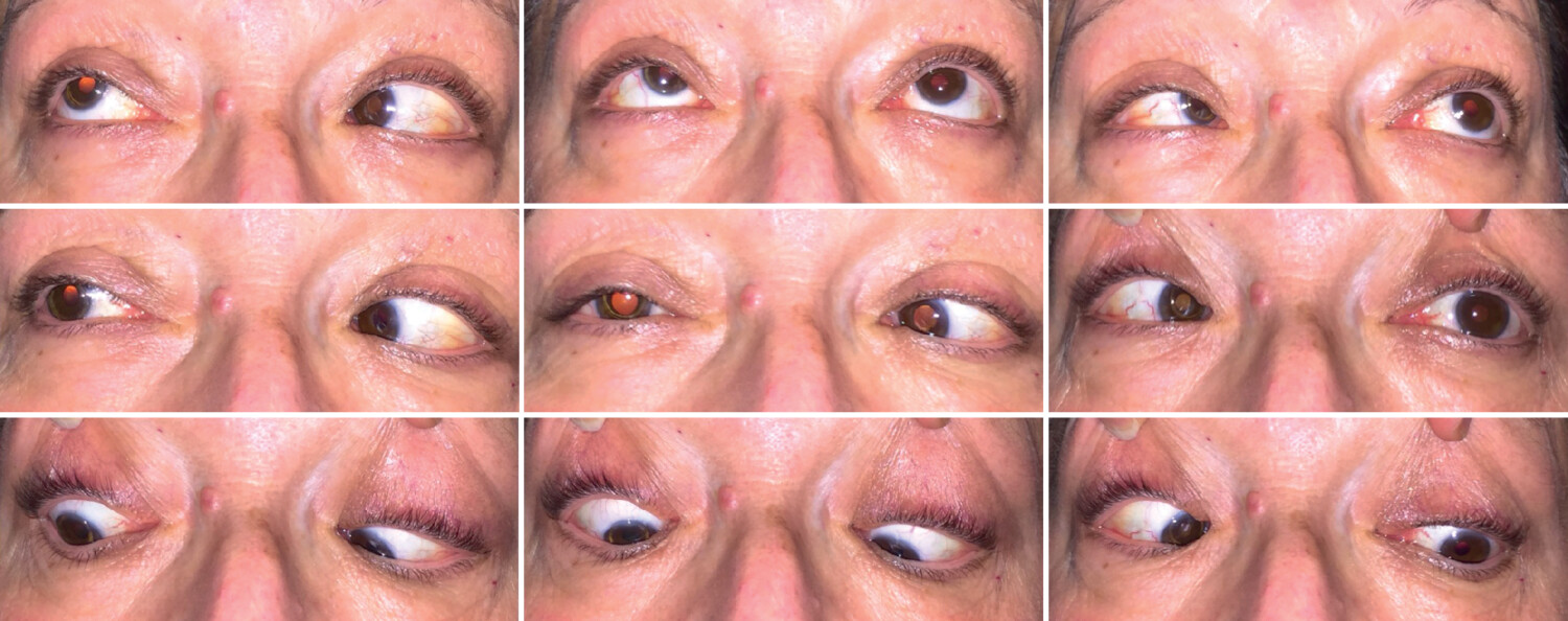 Syndrome de l’œil lourd  - Figure 1