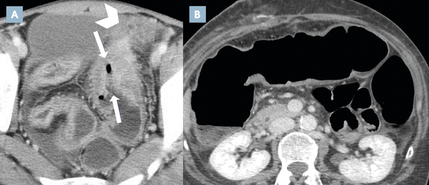 Imagerie en coupes actuelle de la maladie de Crohn (2e partie)  - Figure 4