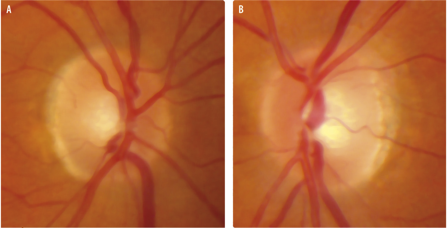 Pièges diagnostiques d'une baisse d'acuité visuelle progressive - Figure 1