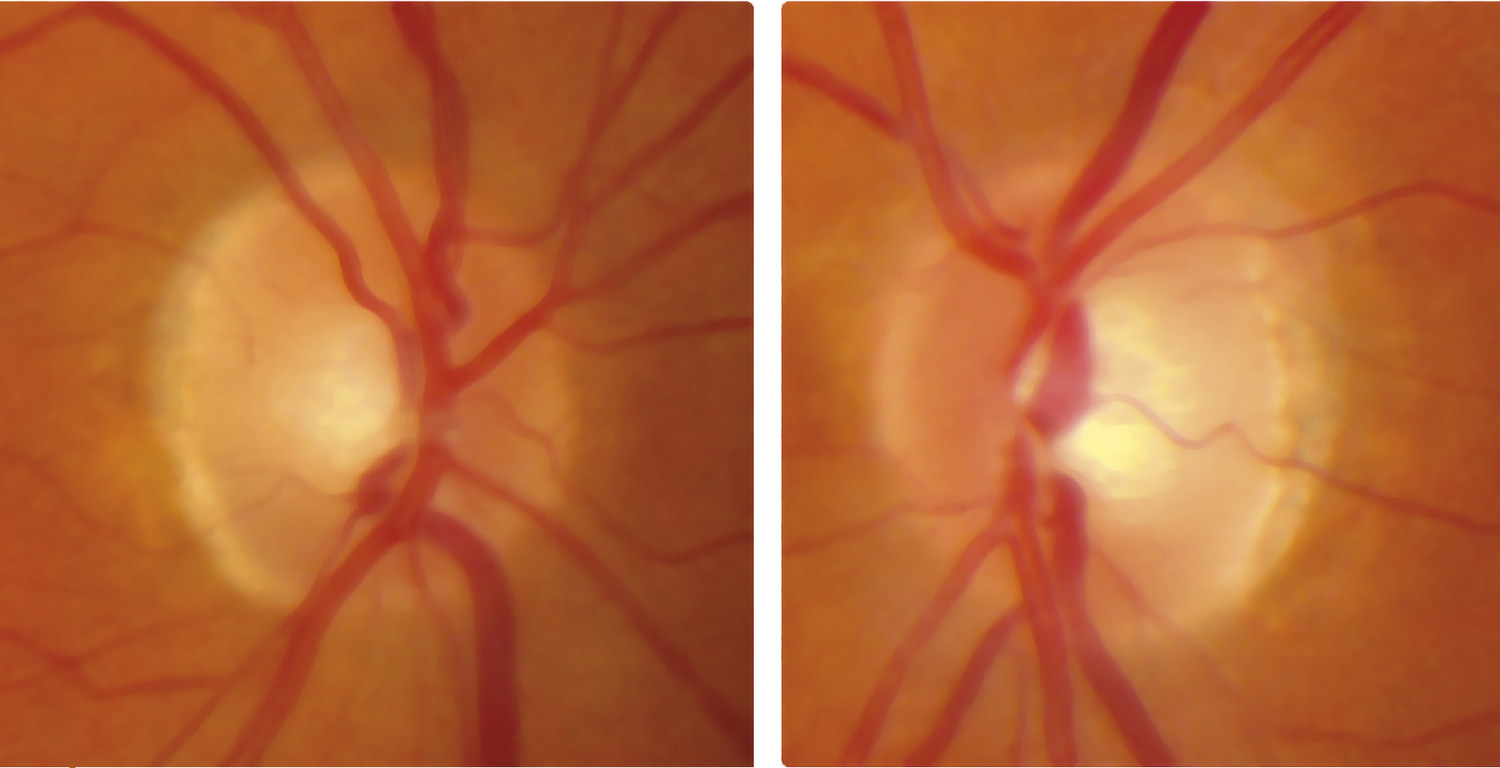 Pièges diagnostiques d'une baisse d'acuité visuelle progressive - Figure 1.