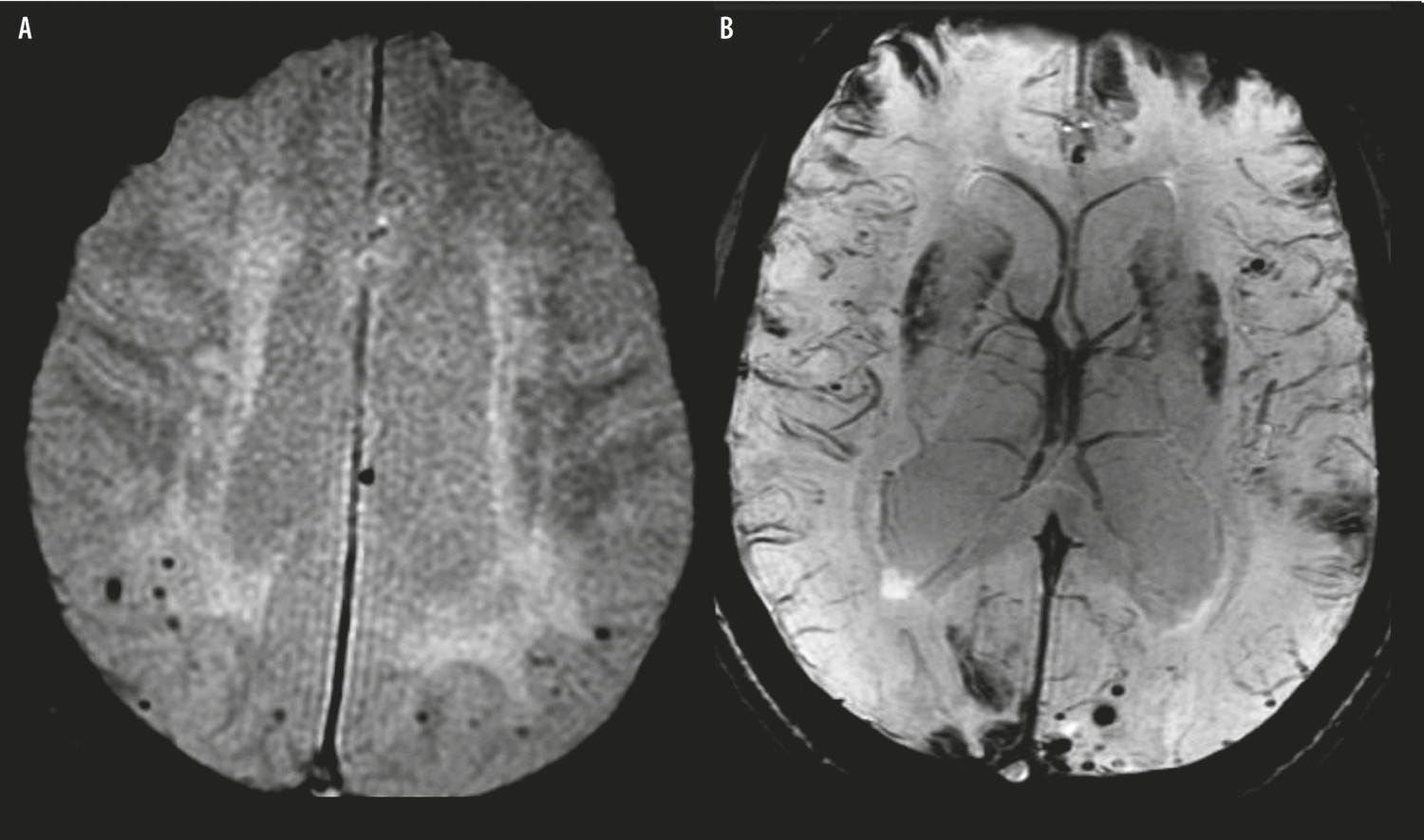 Microsaignements cérébraux et utilisation des traitements en neurologie vasculaire - Figure 1