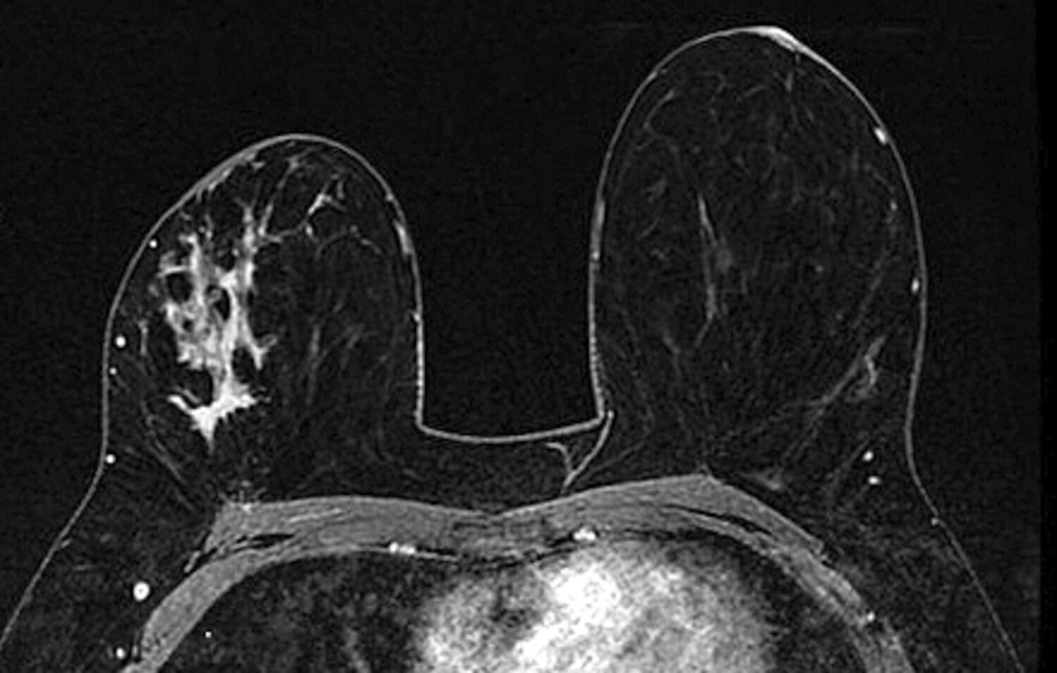 L’IRM mammaire chez les femmes présentant un variant BRCA pathogène de prédisposition au cancer du sein  - Figure 4