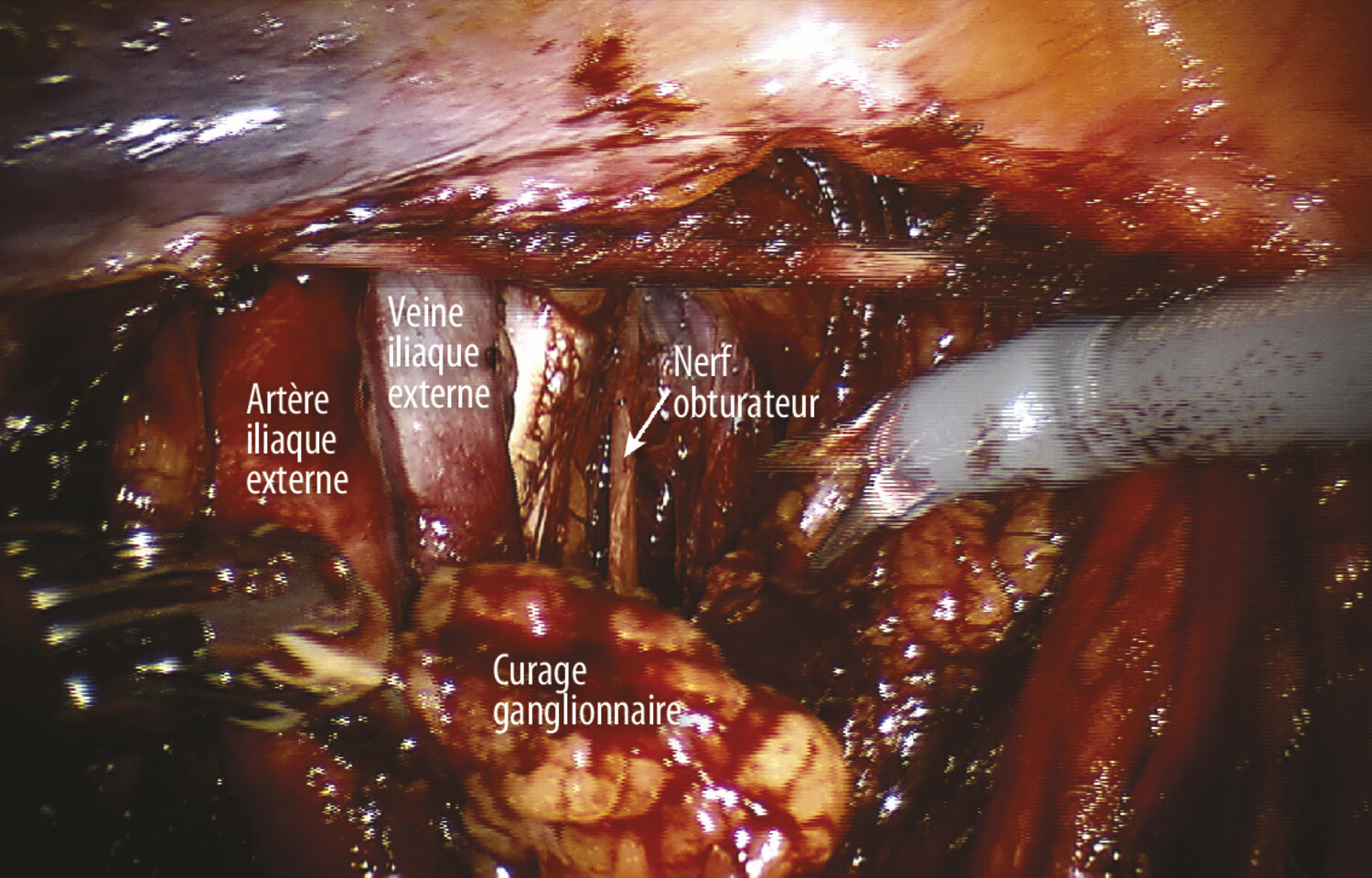 Chirurgie par robot dans les cancers de la prostate - Figure 3