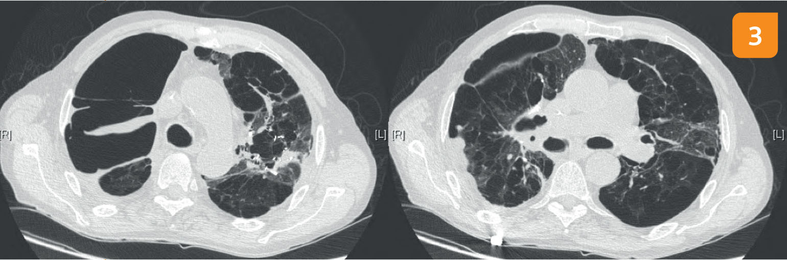 Pneumothorax et coils - Figure 3