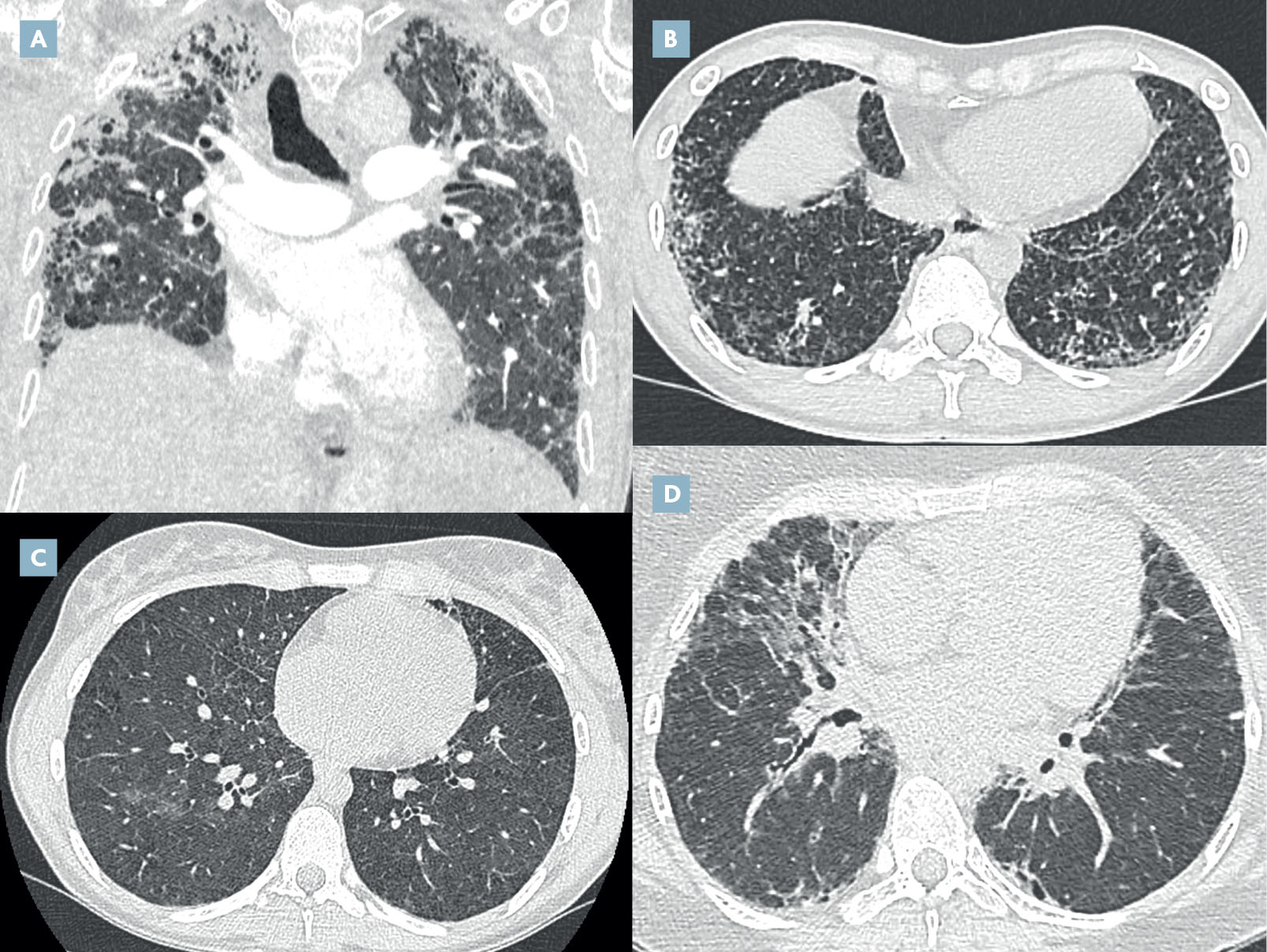 Génétique de la fibrose pulmonaire - Figure 2