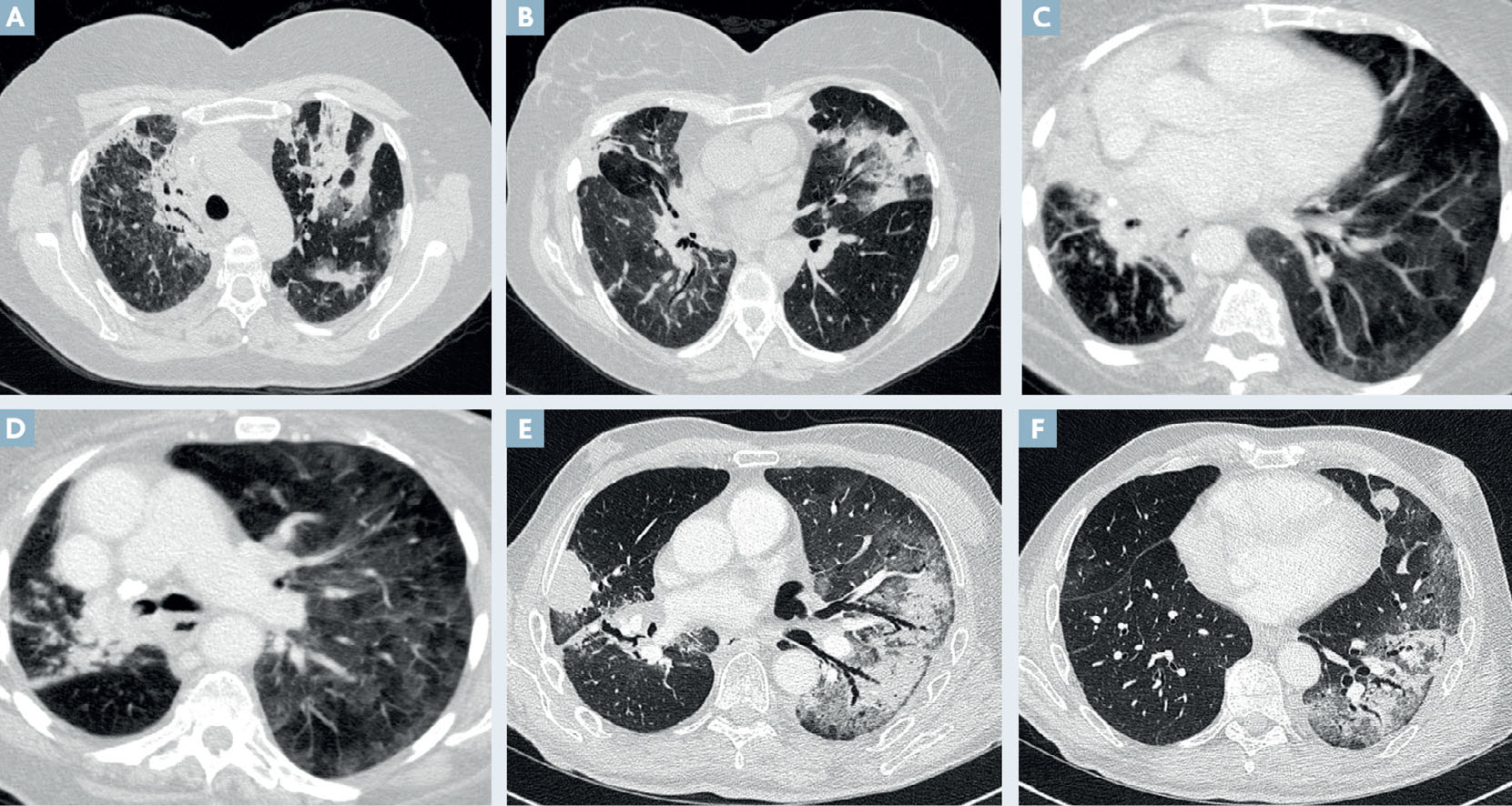 Toxicité pulmonaire induite par les inhibiteurs des points de contrôle de l'immunité - Figure 1.