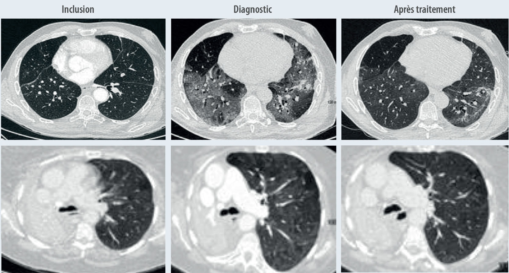 Toxicité pulmonaire induite par les inhibiteurs des points de contrôle de l'immunité - Figure 2.