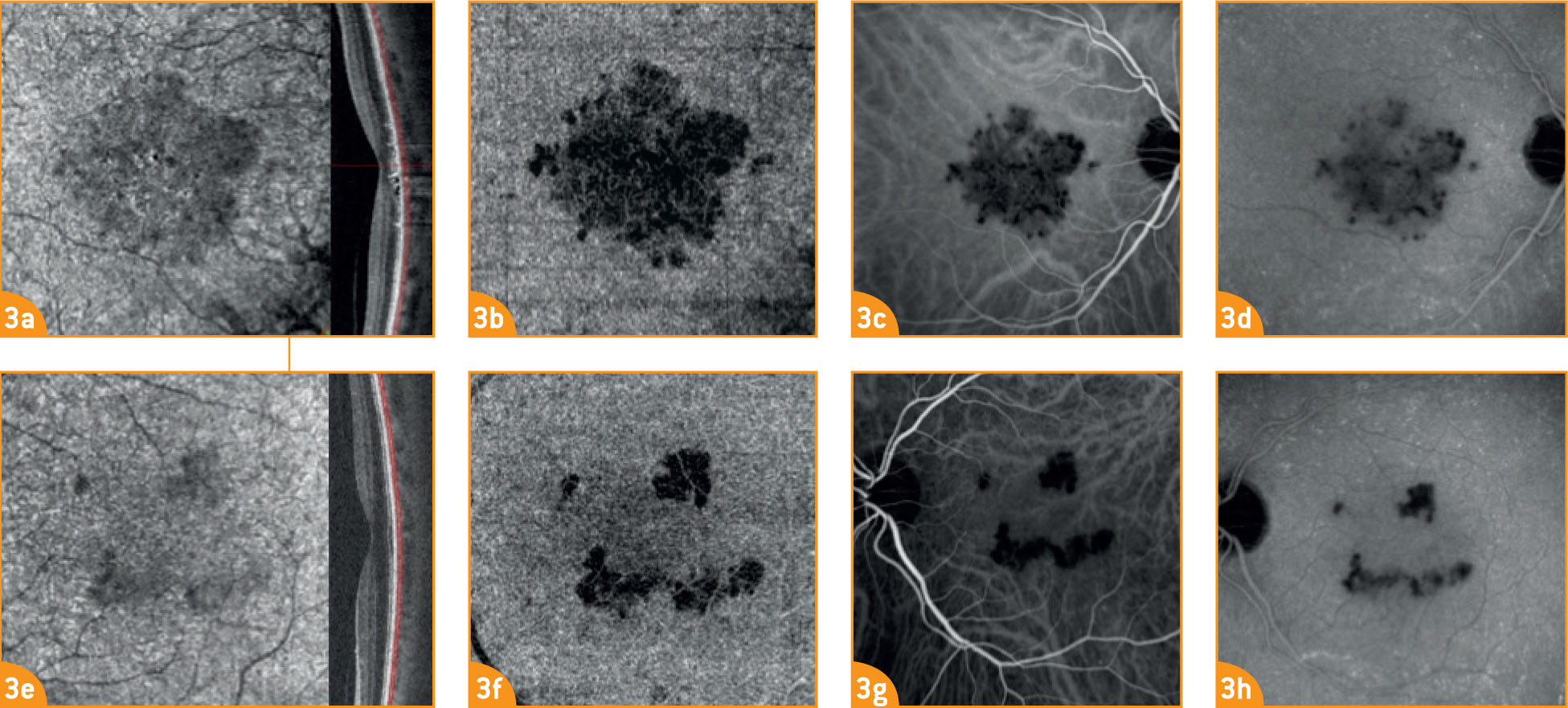 Maculopathie en plaques persistante documentée en angio-OCT - Figure 3