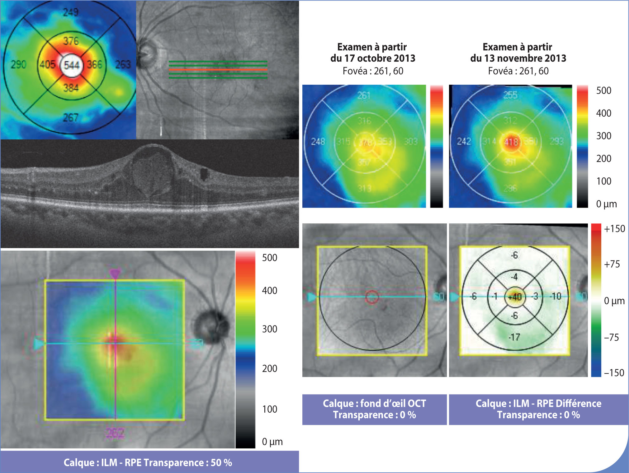 Bilan d'imagerie d'un œdème maculaire diabétique en OCT et en angiographie à la fluorescéine - Figure 4