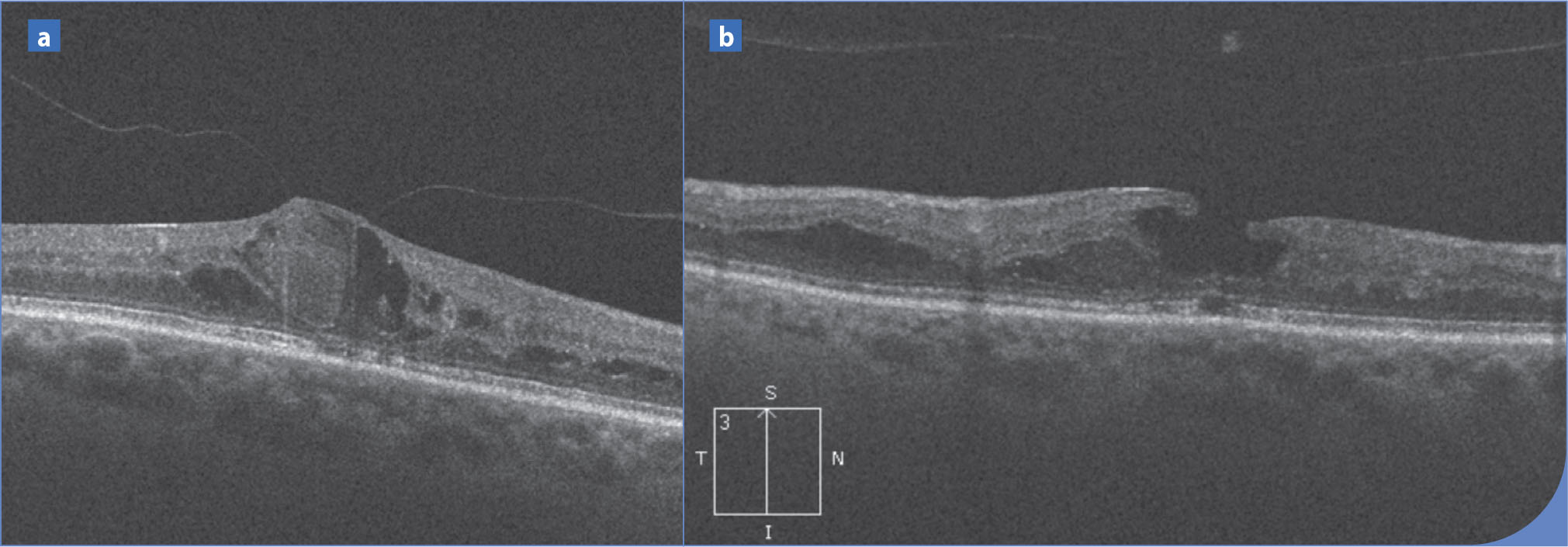 Bilan d'imagerie d'un œdème maculaire diabétique en OCT et en angiographie à la fluorescéine - Figure 5