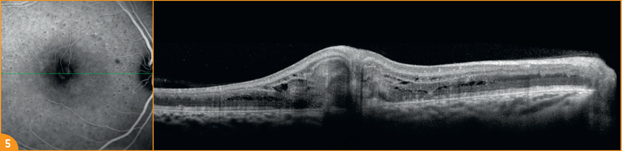 Une anastomose rétino-rétinienne chez un jeune garçon de 10 ans - Figure 5